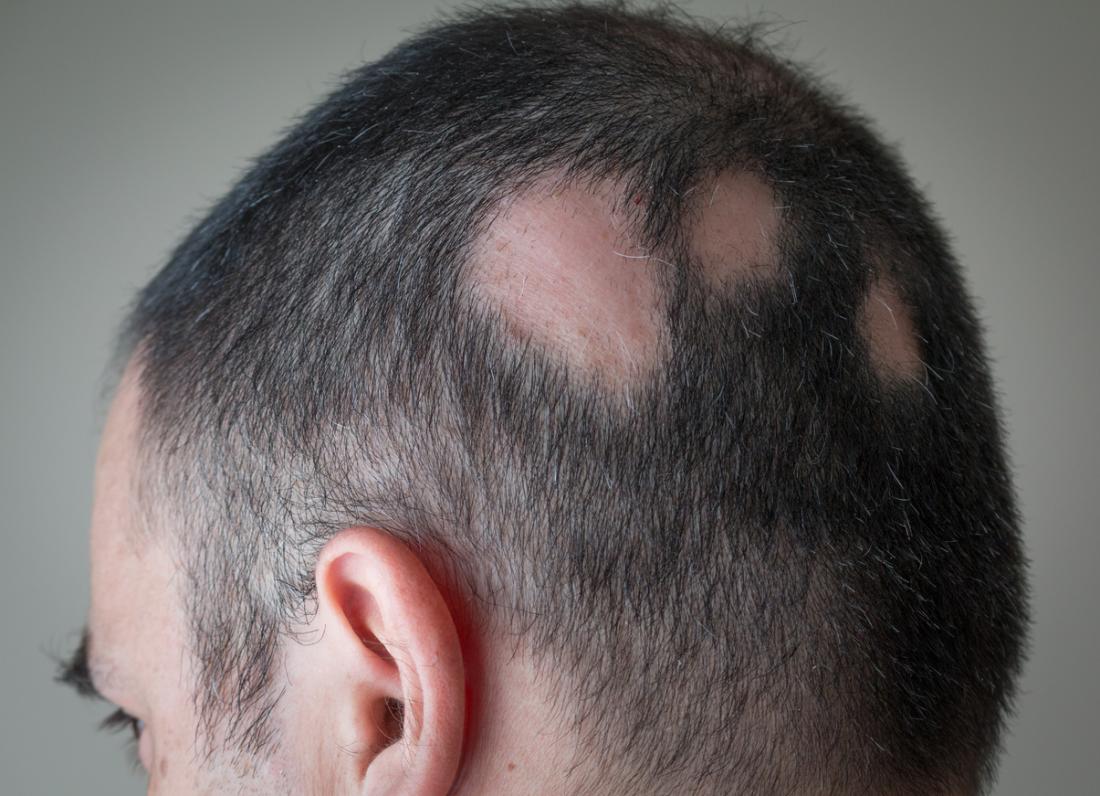 Alopecie areata