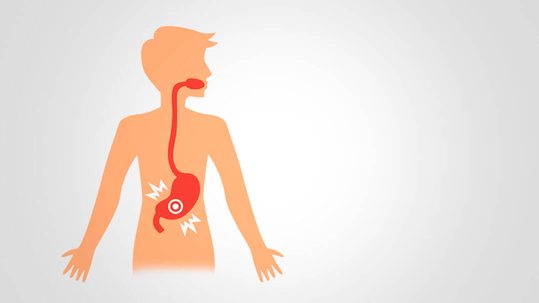 Gastropatie:onemocnění žaludku