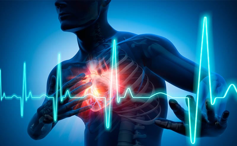 Infarkt