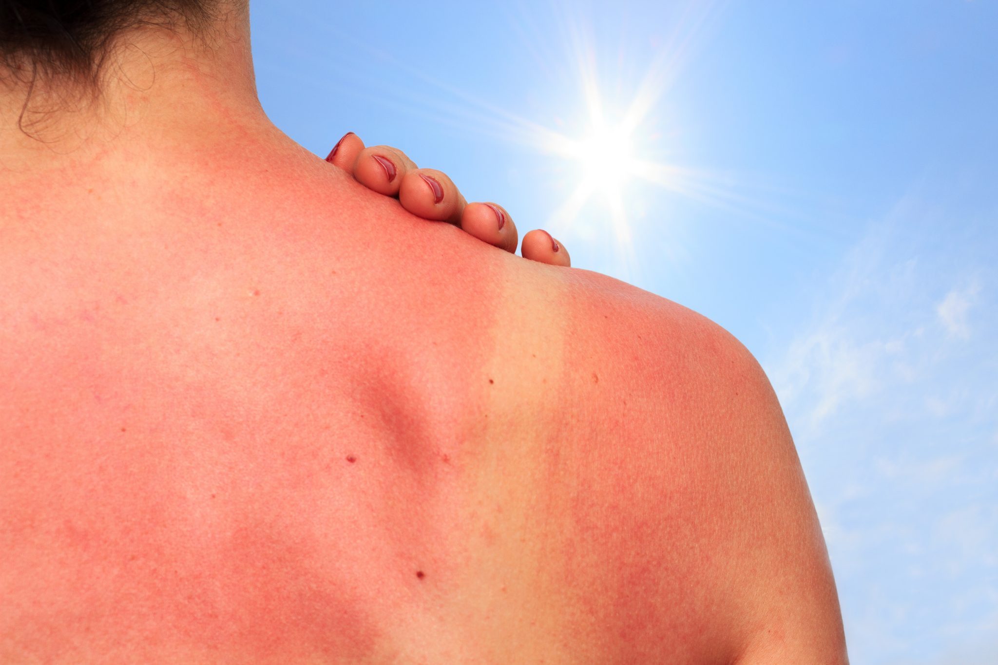 Spálení sluncem: 8 způsobů domácí léčby