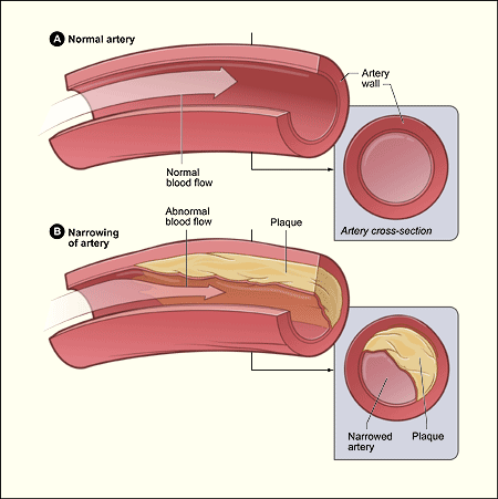 ateroskleroza