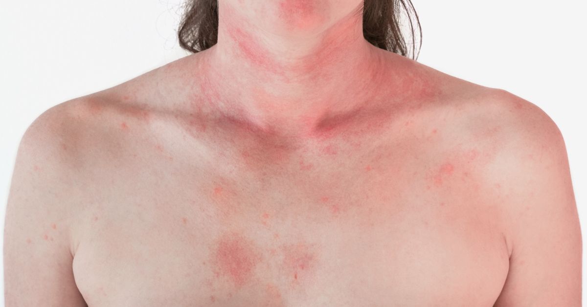 histamin