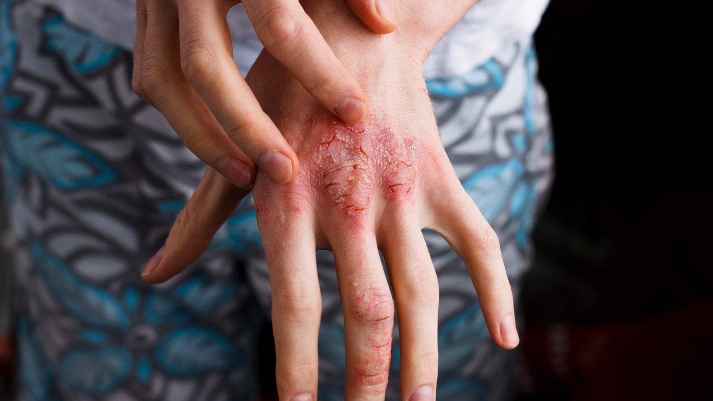 Atopická dermatitída (ekzém)