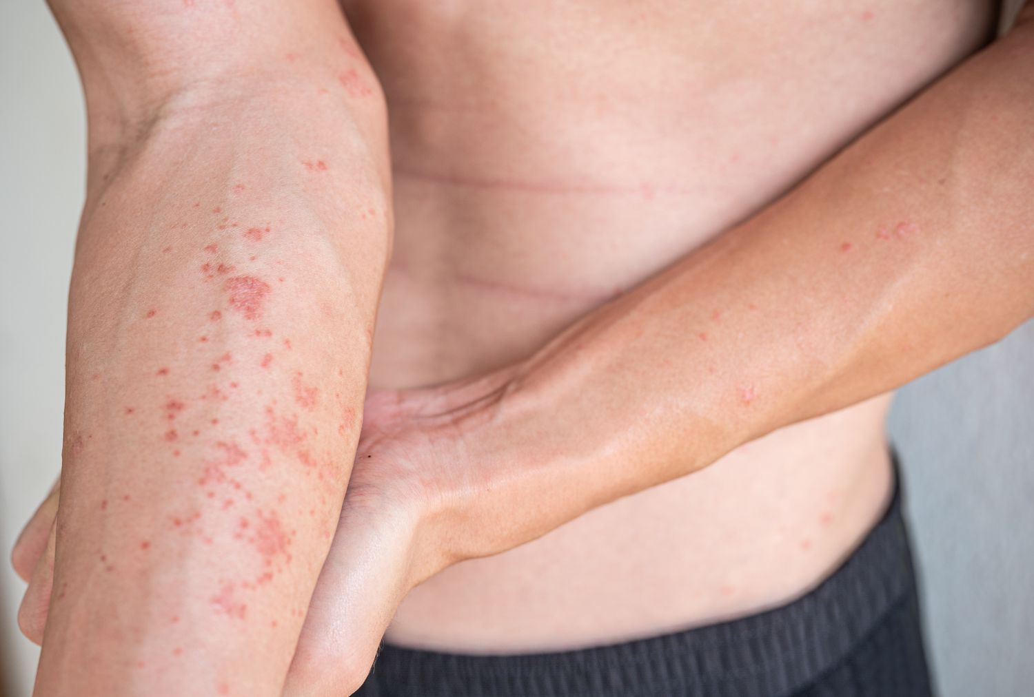 Čo je dermatitída?