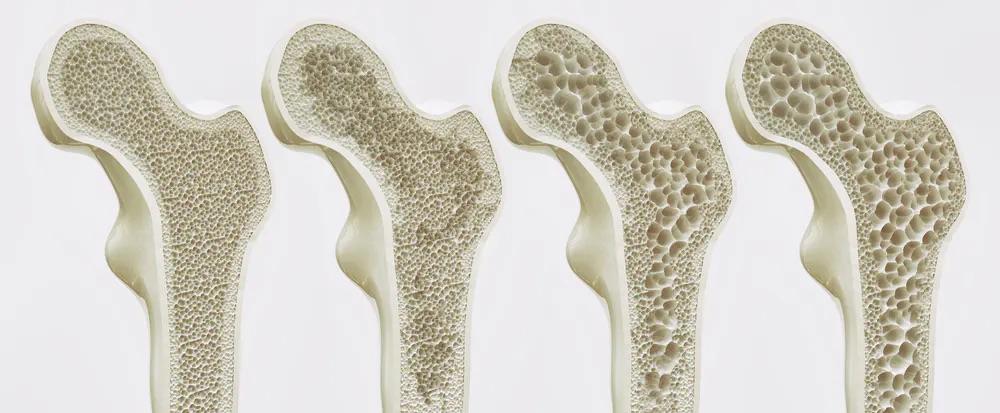 Pomáha kolagén pri osteoporóze?