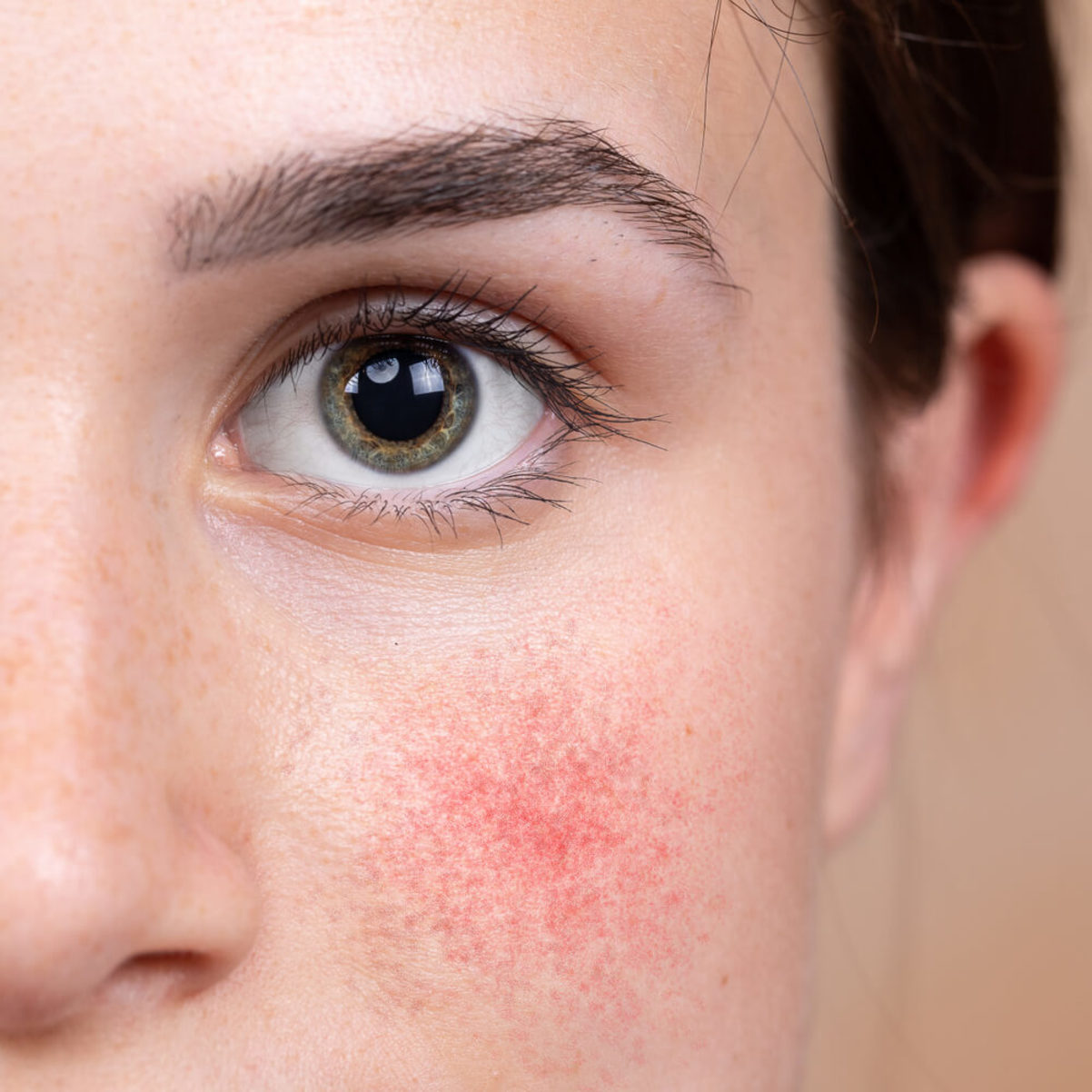 Lupus