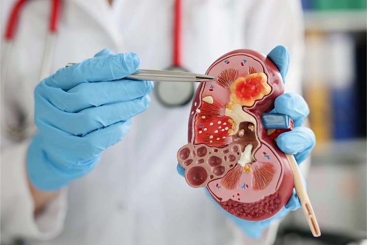 Močové kamene: príčiny, príznaky a prevencia
