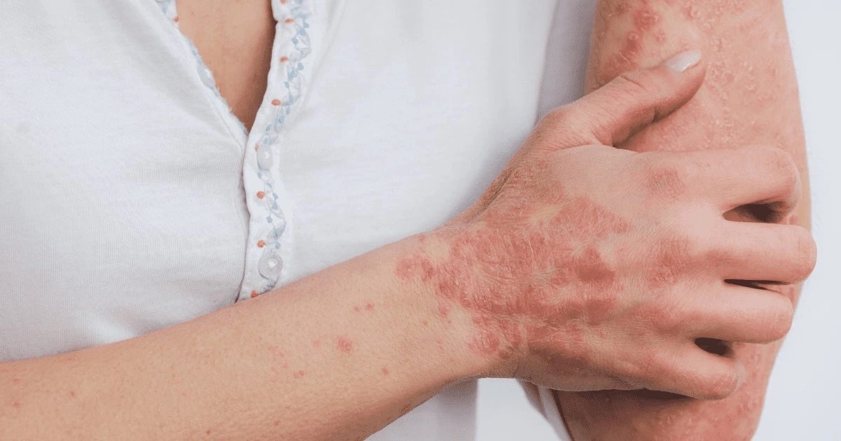 Ako črevá ovplyvňujú pleť: Probiotiká v boji proti akné, rosacei a ekzémom