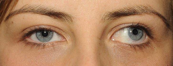Strabizmus (šilhanie)