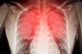 Pneumonitída (zápal pľúc)