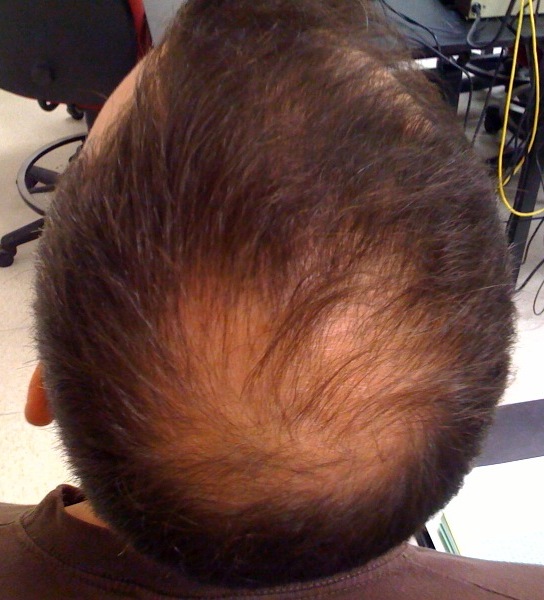 Alopecia: Strata vlasov a jej príčiny, symptómy a liečba