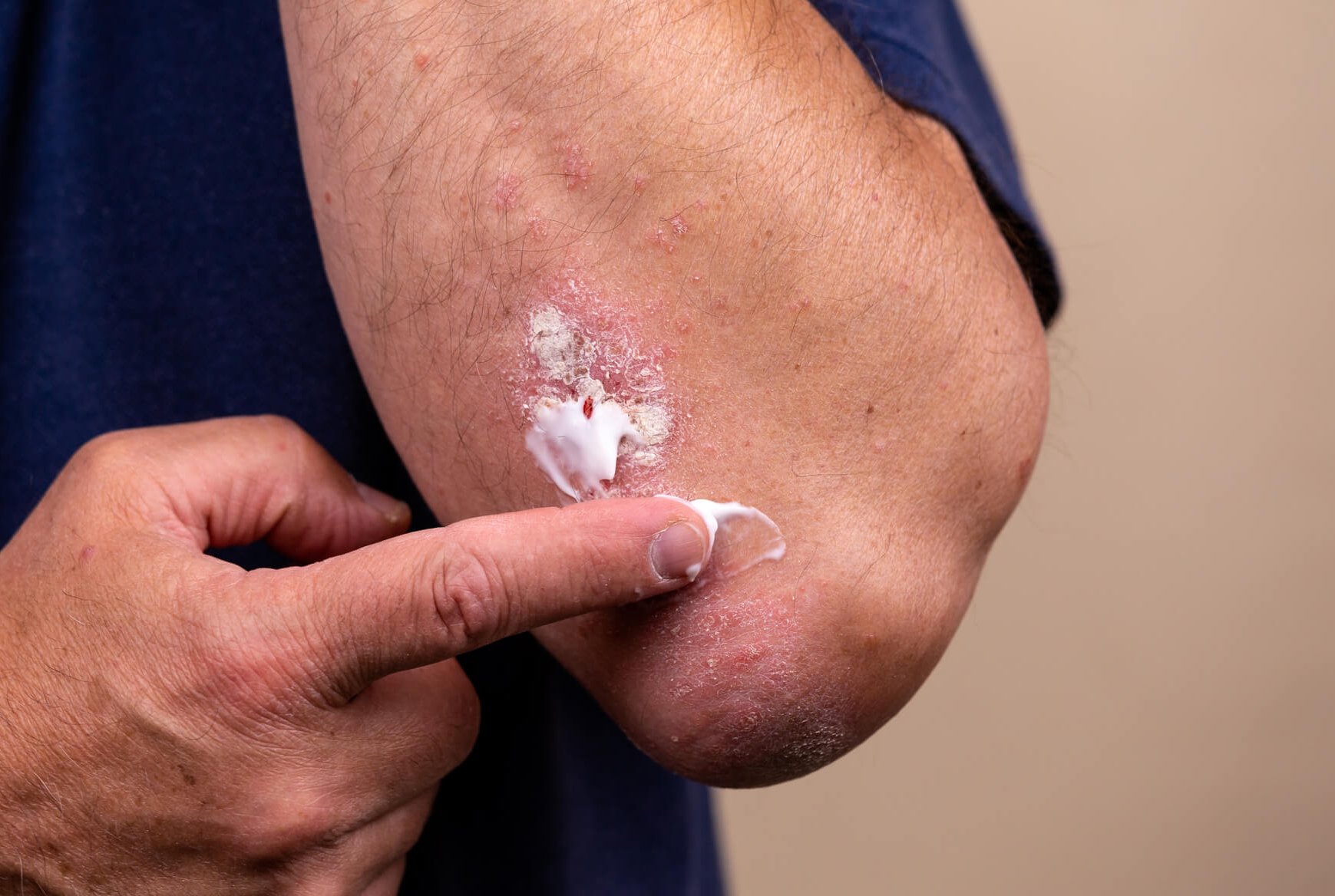 Kĺby a autoimunitné ochorenia: čo hovorí veda?