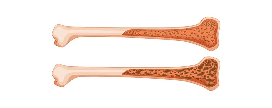 Zlyhanie kostnej drene