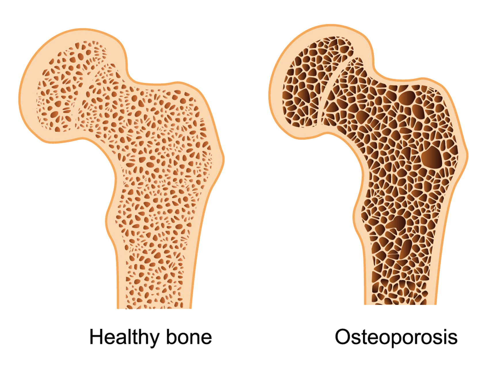 Osteoporóza