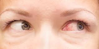 Zapálene oko, aké sú rôzne typy očných zápalov?