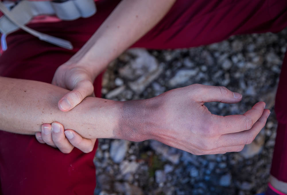 Zlomenina zápästia