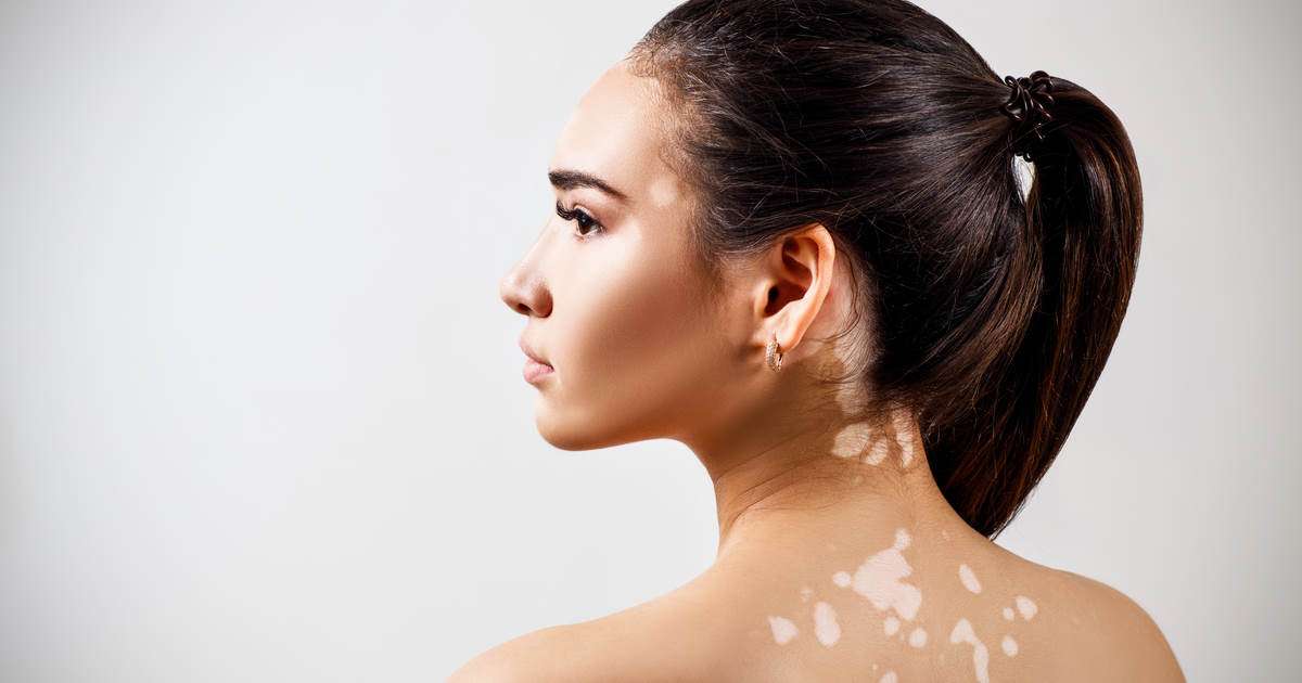 vitiligo