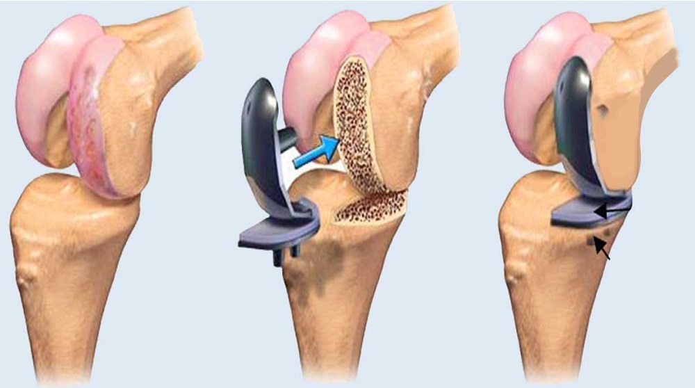 Artroplastika