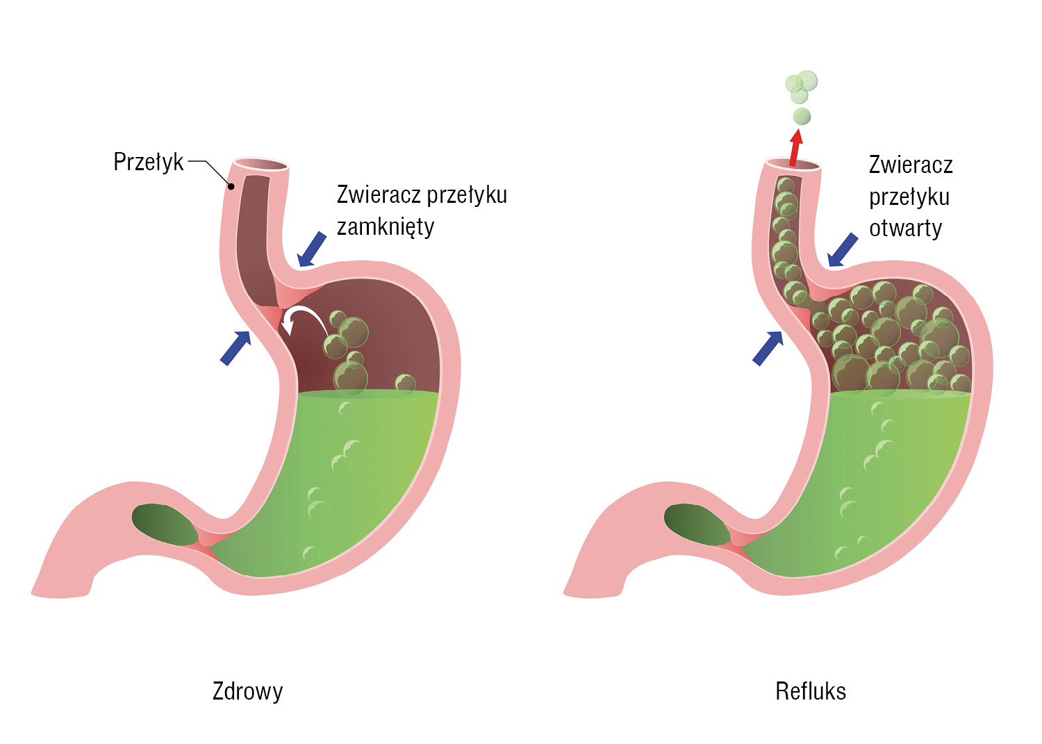 Wszystko, co musisz wiedzieć o refluksie i chorobie refluksowej przełyku