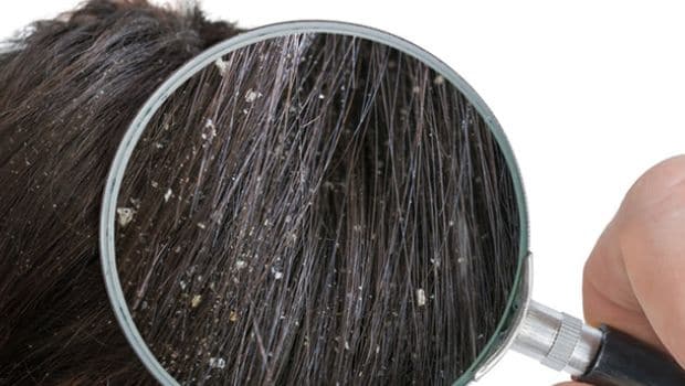 vfoh6eh8_dandruff_625x300_08_August_18