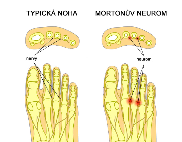 Statické deformity přednoží, Mortonův neurom
