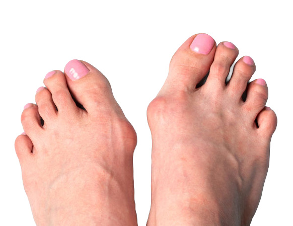 Deformita palce nohy - Hallux valgus