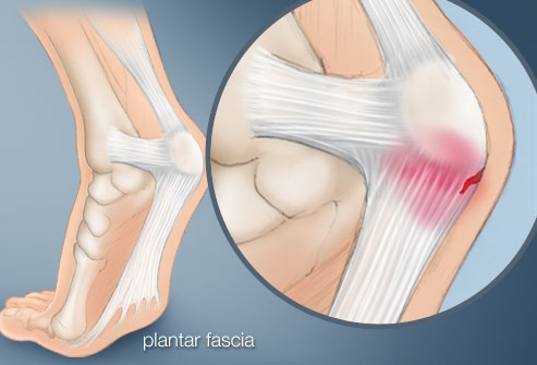 Plantární fasciitis a bolesti paty