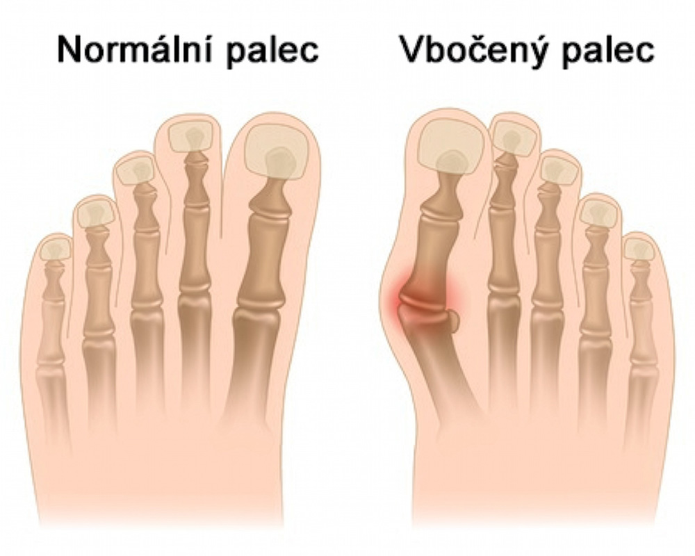Proč vzniká vbočený palec (hallux valgus) a jak se deformita postupně zhoršuje