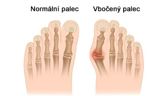 Deformita palce nohy - Hallux valgus