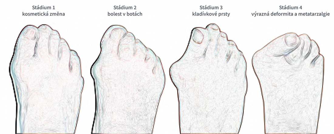 Fáze a průběh vbočeného palce