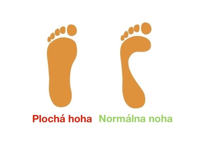 Plochá noha a padnutá klenba: čo pomáha a čomu sa vyhnúť