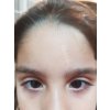 FORSCARBEFORE AFTERFORHEAD AFTER