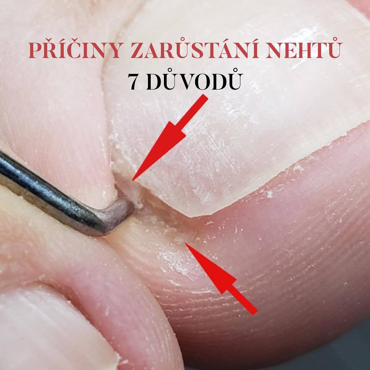 Příčiny zarůstaní nehtů