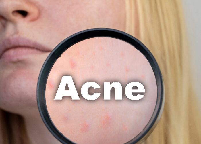 Proč se mi zhoršila pleť po třicítce? Toto jsou nejčastější důvody u dospělých žen