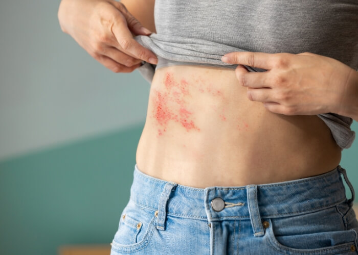 Pásový opar - příčiny, příznaky a jak se ho zbavit