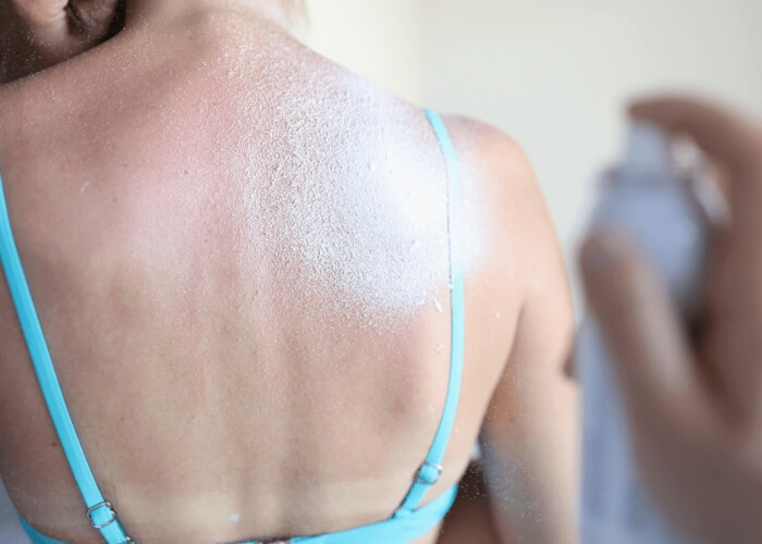 Co na spálenou kůži? Rady i tipy, jak postupovat při spálení pokožky od slunce