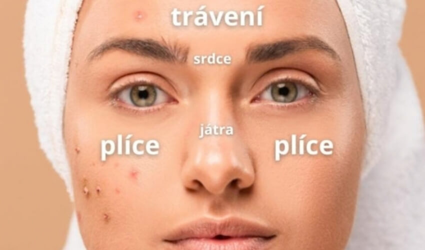 Příčina akné podle místa výskytu na obličeji