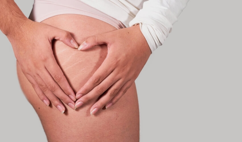 Strie na stehnech po porodu a péče o pružnost kůže