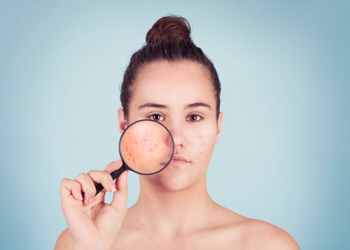 Ako sa zbaviť akné? Krok za krokom, čo presne robiť