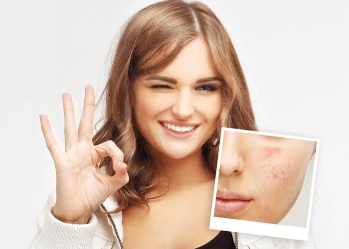 Ako sa zbaviť jazvičiek po akné a pigmentových škvŕn?