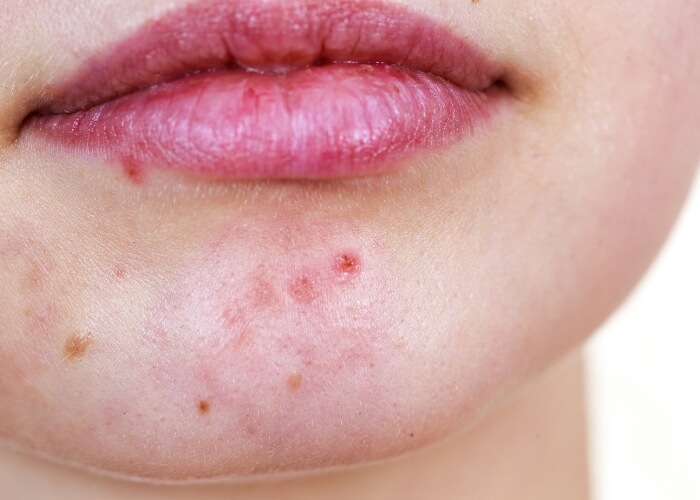 Akné na brade a čeľusti: čo často znamená a prečo sa vracia stále dokola