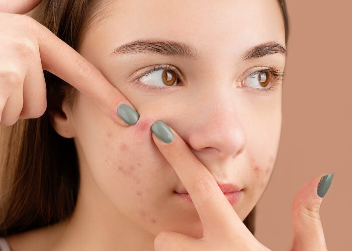Máš suchú pleť, ale zároveň pupienky. Čo robiť? Je to jednoduchšie, než si myslíš