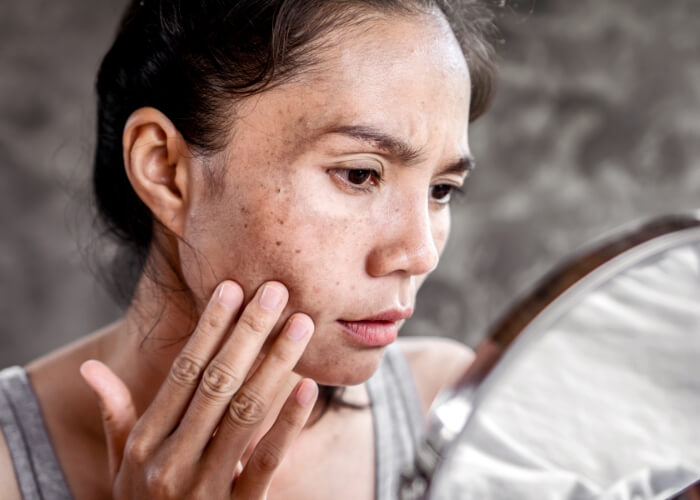 Pigmentové škvrny: Ako vznikajú a ako sa ich zbaviť?