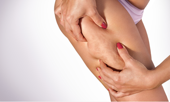 Jak se zbavit celulitidy? Ověřené metody, které skutečně fungují