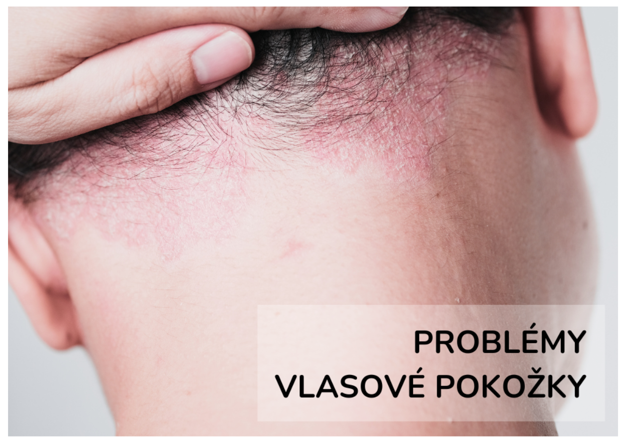 Problematika vlasové pokožky