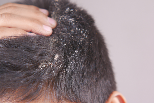 Trápí vás lupy nebo jiné onemocnění vlasové pokožky? Pomůžeme Vám!