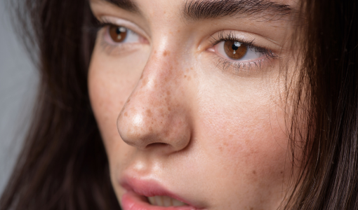 Jak vyzrát na pigmentové skvrny