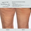 WellSpa iO before after 3min 3x tigh 600x600 bc87582