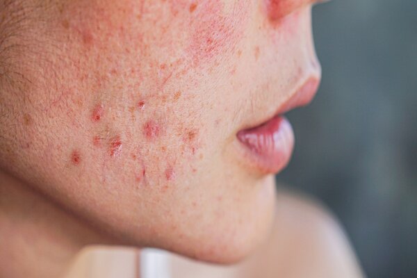Hormonální akné (Acne tarda): Co to je, proč vzniká a jak ho léčit