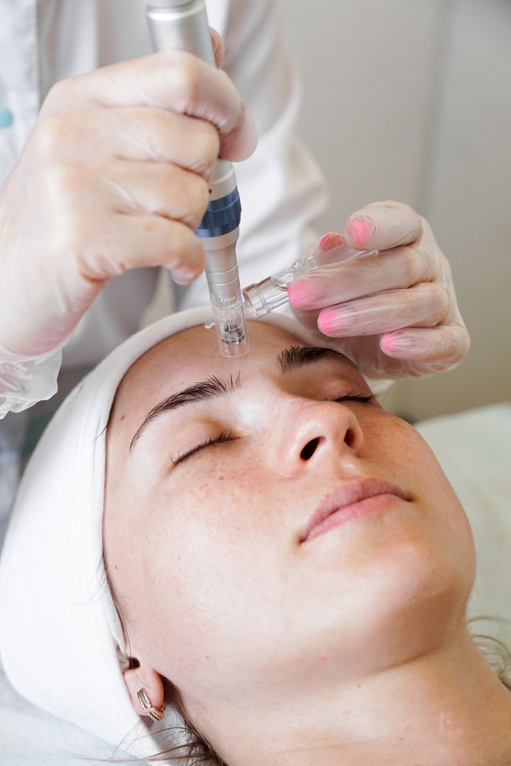 microneedling